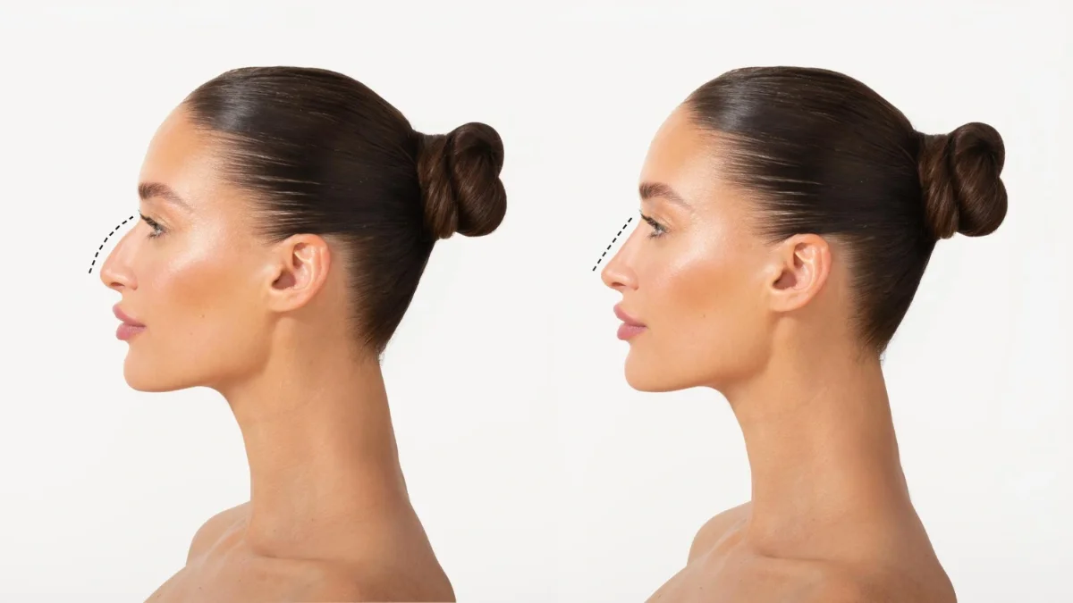 Perfectus Clinica kampanija